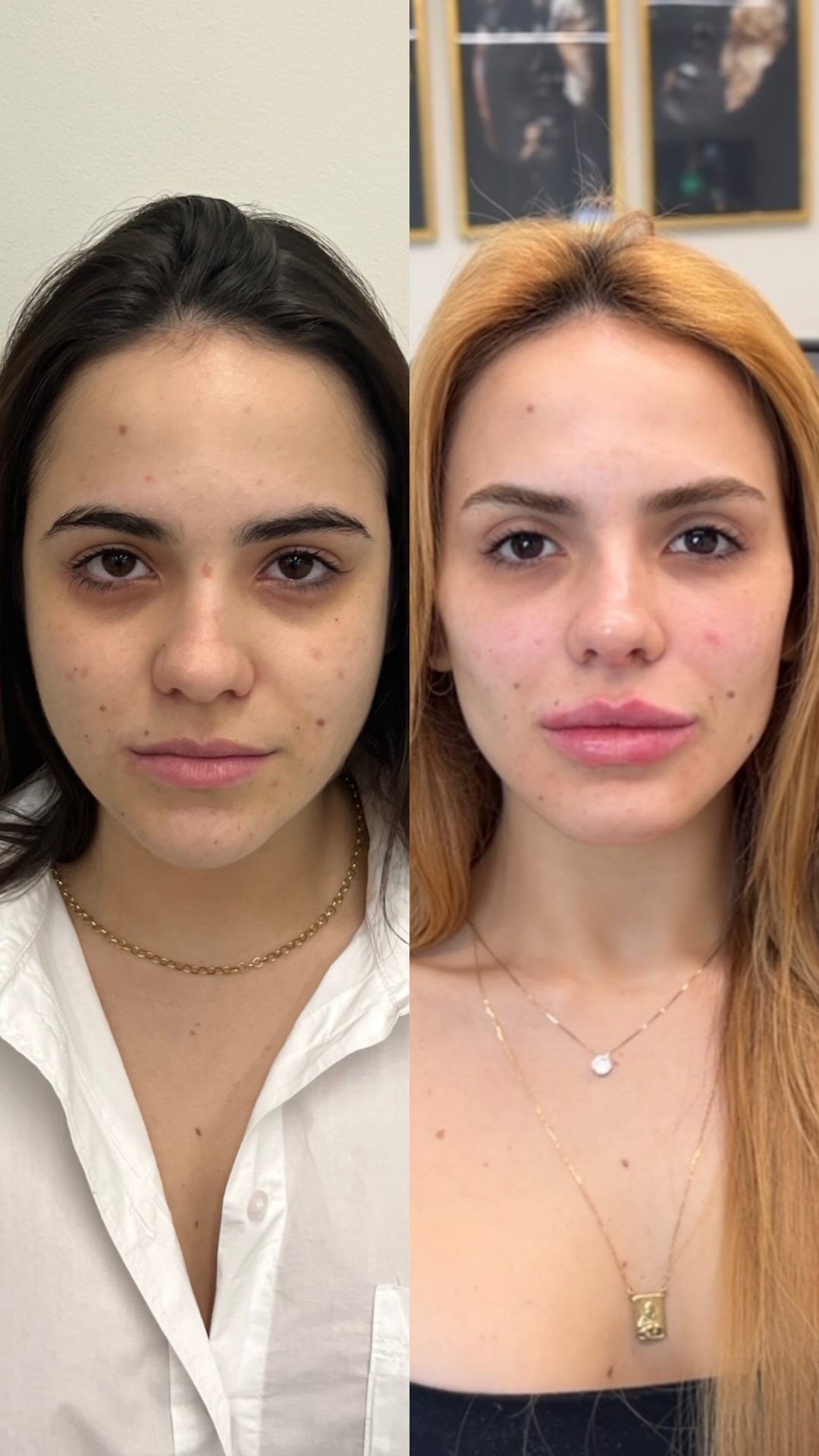 Antes e depois — resultado real 1 de harmonização facial